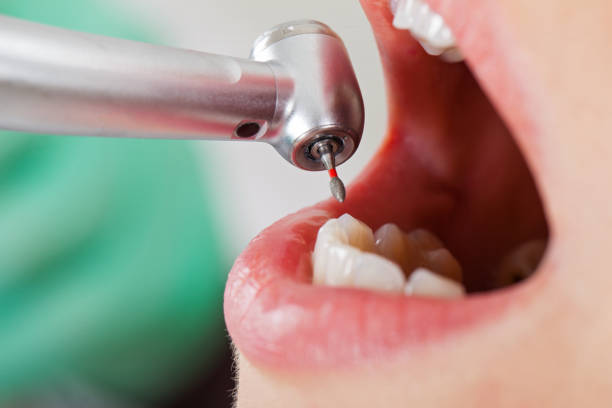Best Emergency Tooth Extraction in Leesburg, GA